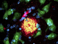 新冠病毒及疫苗是引发阿尔茨海默病的危险因素吗?#脑雾 #多次新冠感染 #轻度认知缺陷